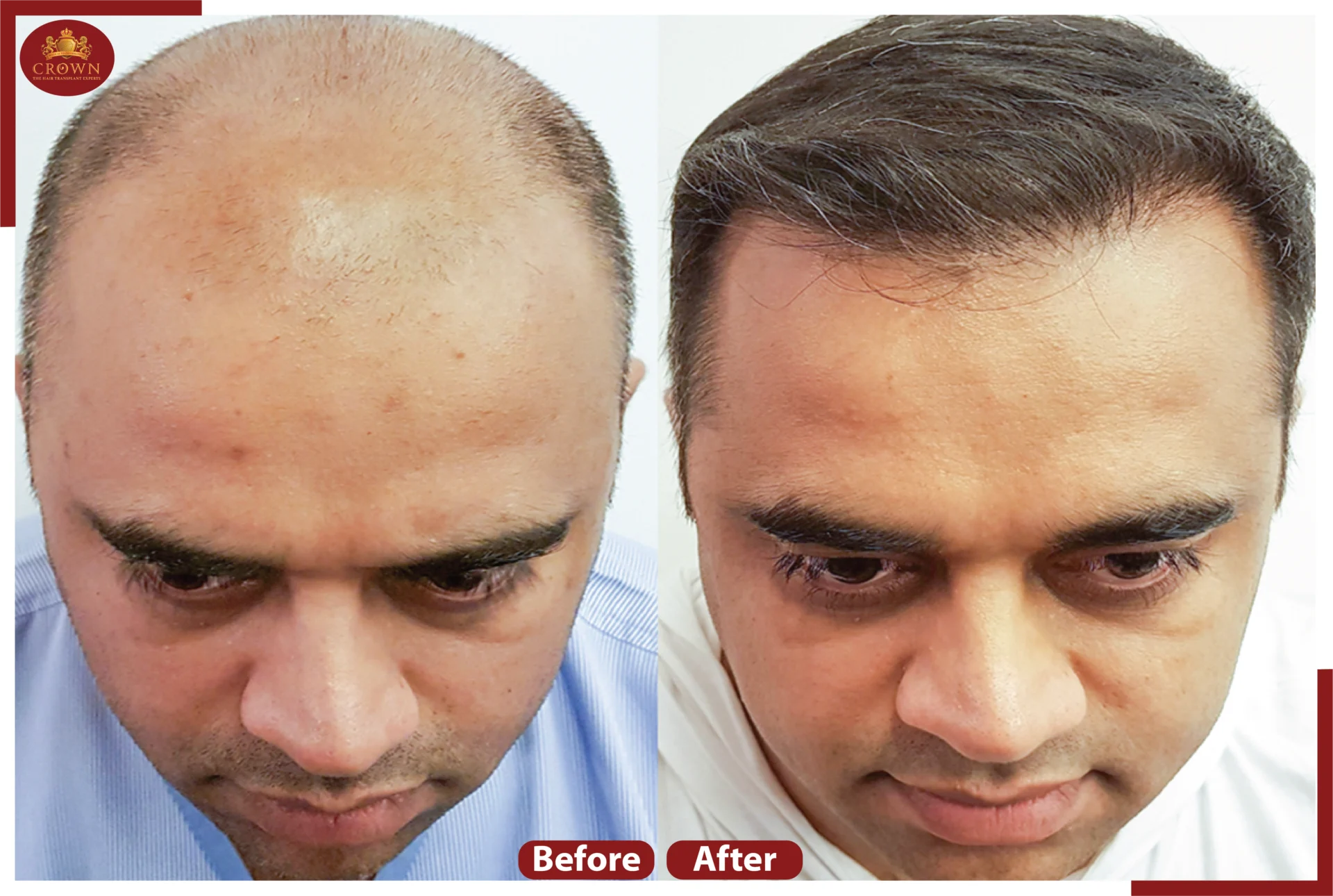Crown – The Hair Transplant Experts