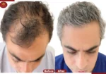 Crown – The Hair Transplant Experts