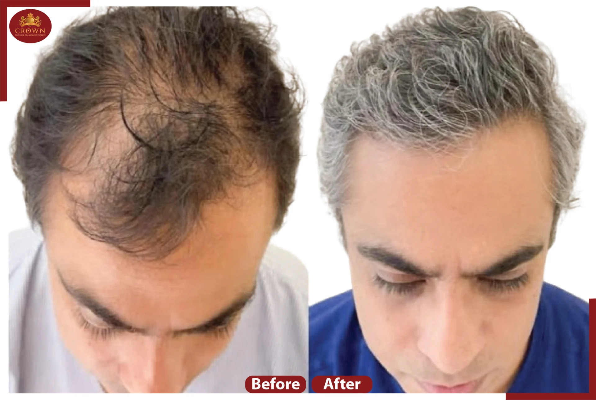 Crown – The Hair Transplant Experts