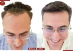 Crown – The Hair Transplant Experts