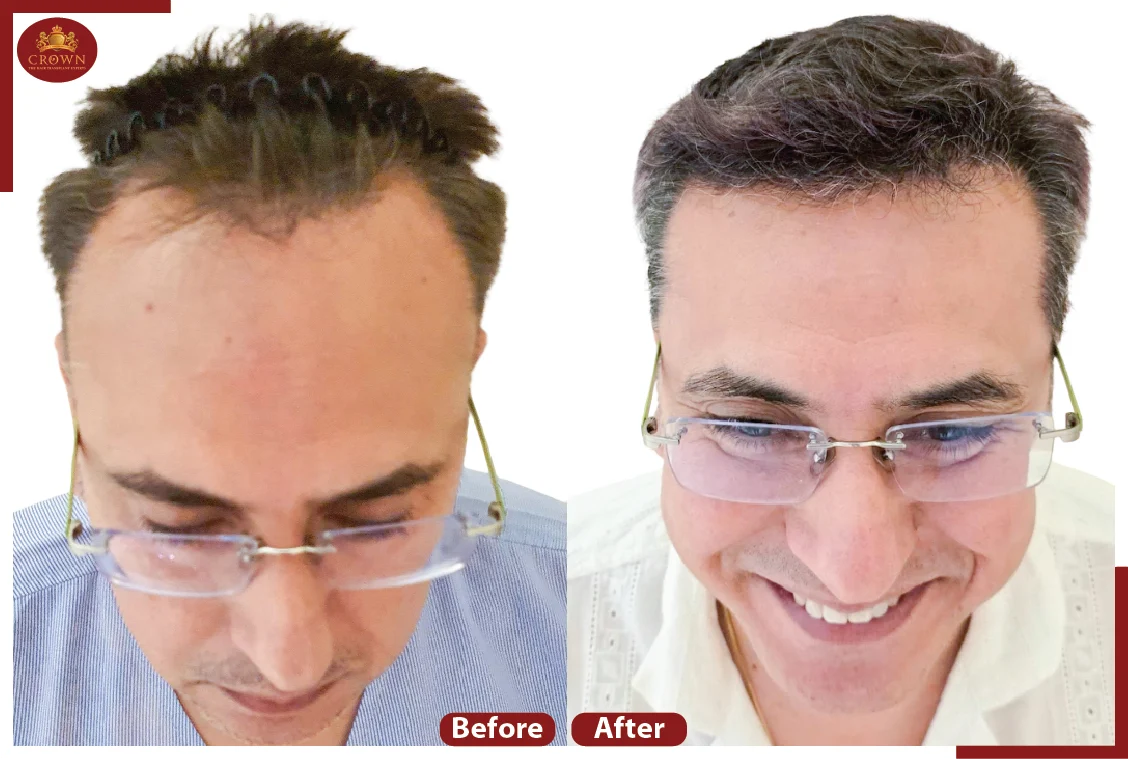 Crown – The Hair Transplant Experts