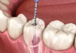 Root Canal Treatment Cost in Noida