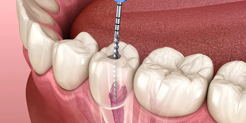 Root Canal Treatment Cost in Noida