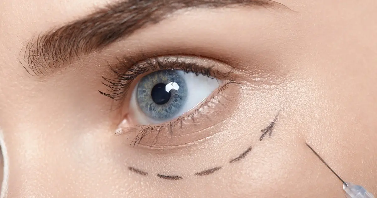 Blepharoplasty in Dubai