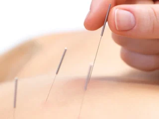 peel-back