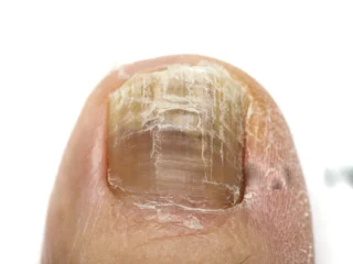 tonail-fungus-treatment2