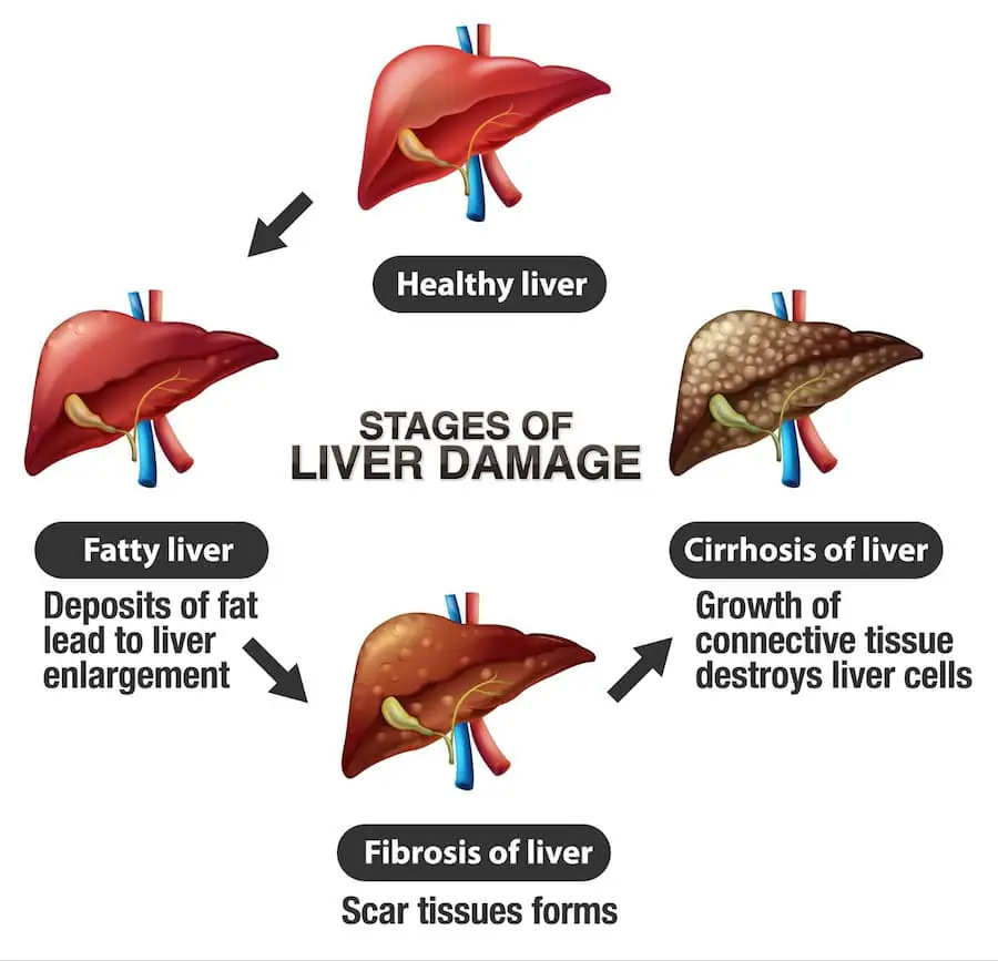 Best liver transplant surgeon in india – Dr Neerav Goyal